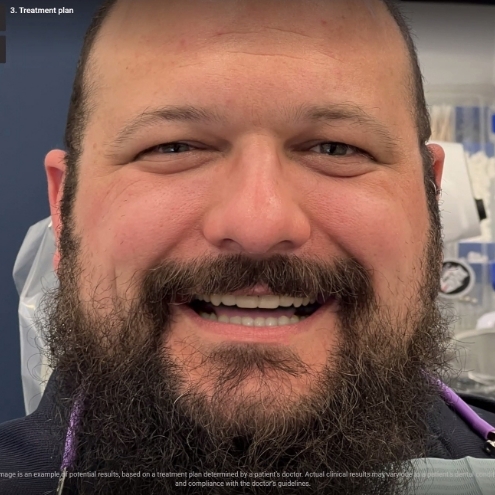 Digital rendering of bearded man after cosmetic dentistry in Sachse