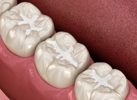 Illustrated row of teeth with barely noticeable dental sealants