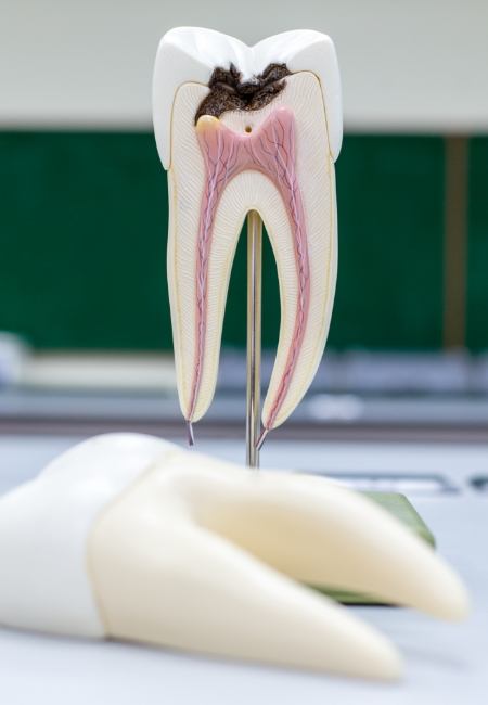 Model of infected tooth needing root canal treatment in Sachse