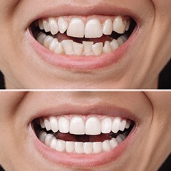 Factors that affect the cost of traditional braces include how much your teeth need to move to get to their ideal position