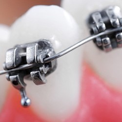 Professional orthodontic treatment straightens your teeth right the first time