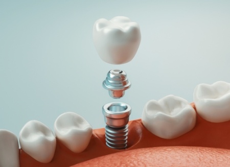 Illustrated dental implant with crown being placed in the lower jaw