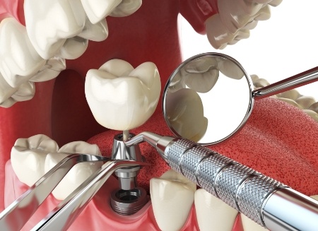 Illustrated dental implant with abutment and crown