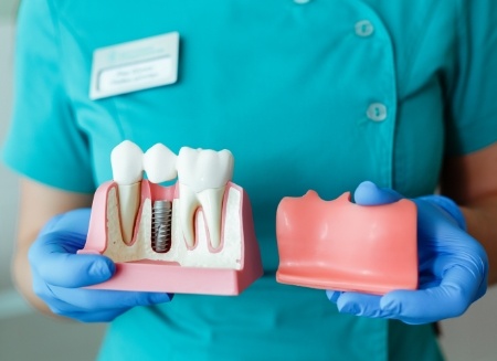 Dentist holding a model of the gums with a dental implant