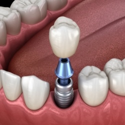 Dental crown being placed onto a dental implant