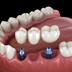 Two dental implants being placed onto a dental bridge