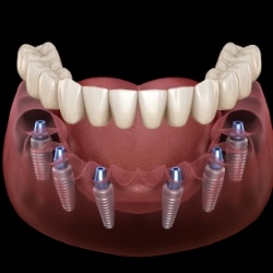 Full denture being placed onto six dental implants