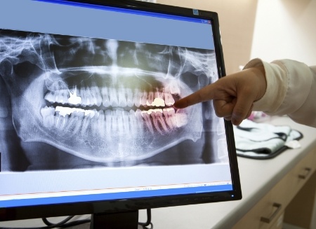 Dentist pointing to screen showing digital x rays of teeth