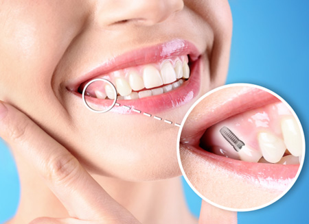 a patient smiling and showing off their dental implant restoration 