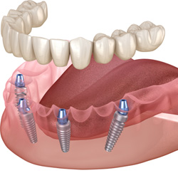 a 3D illustration showing implant-retained dentures 