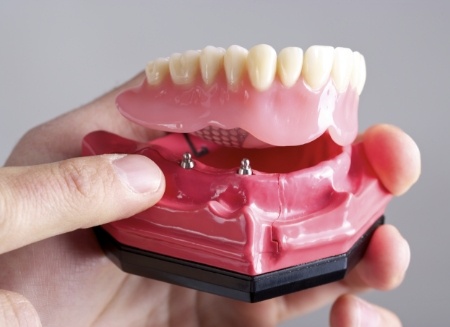 Dentist holding a model of an All on 4 implant denture
