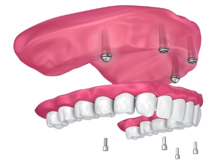 Illustrated denture being placed onto four dental implants