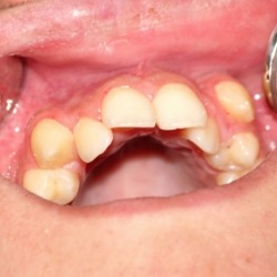 Close up of mouth with crowded teeth
