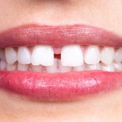 Closeup of patient with gaps between teeth before Invisalign
