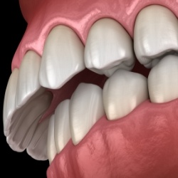 Illustrated mouth with overbite