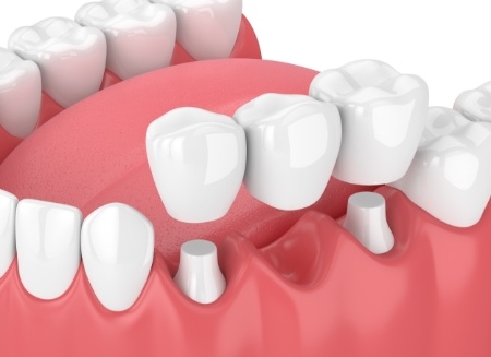 Illustrated dental bridge replacing a missing tooth