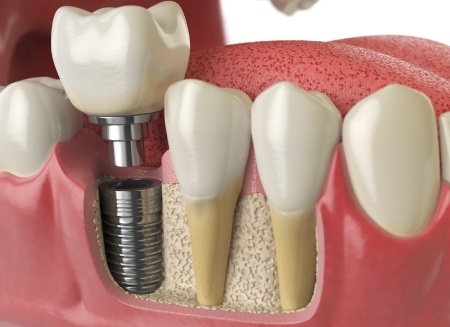 Illustrated dental implant replacing a missing tooth