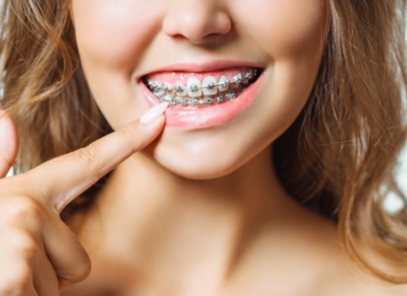 Young woman with braces pointing to her smile