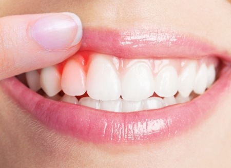 Close up of person pointing to red spot in their gums