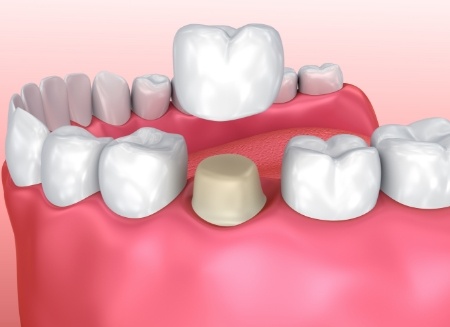 Illustrated dental crown being fitted over a tooth