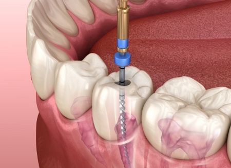 Illustrated dental instrument cleaning the inside of a tooth
