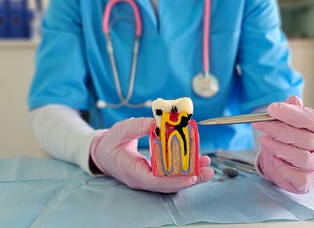 A dentist showing a patient a model of an infected tooth