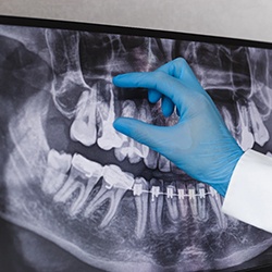 A dentist showing a patient an X-ray of a tooth infection