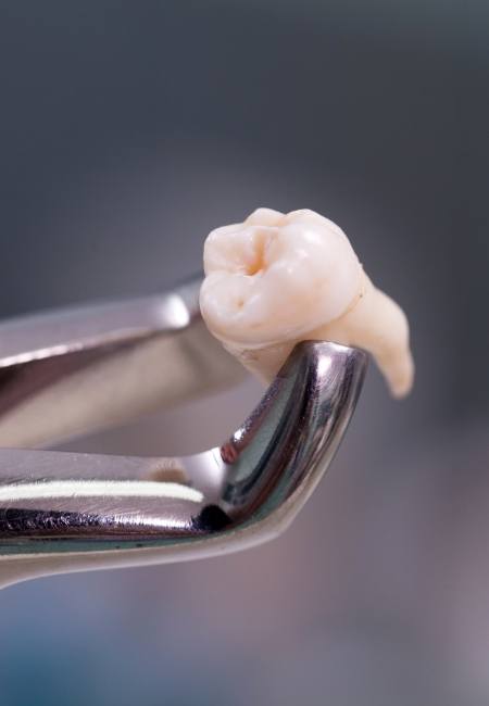 Dental forceps holding a tooth after tooth extractions in Sachse