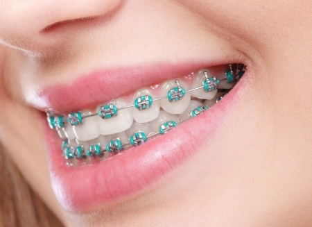 Close up of smile with traditional braces and blue green brackets