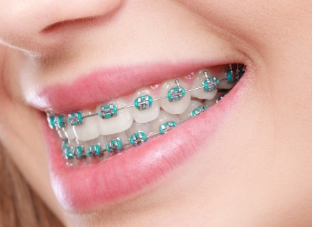 Close up of smile with traditional braces and blue green brackets