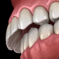 Illustrated mouth with overbite