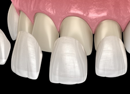 Several illustrated veneers being placed on upper front teeth