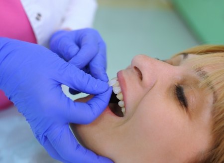 Cosmetic dentist placing veneer over front tooth of a patient