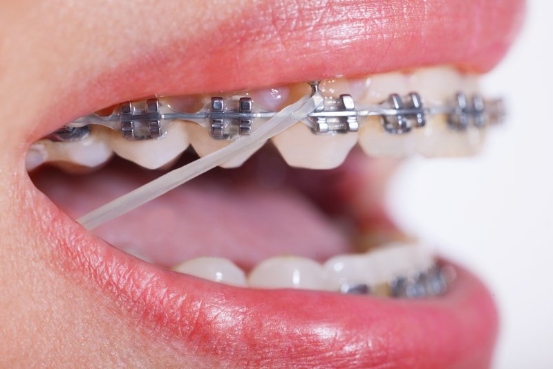 Braces with rubber band.