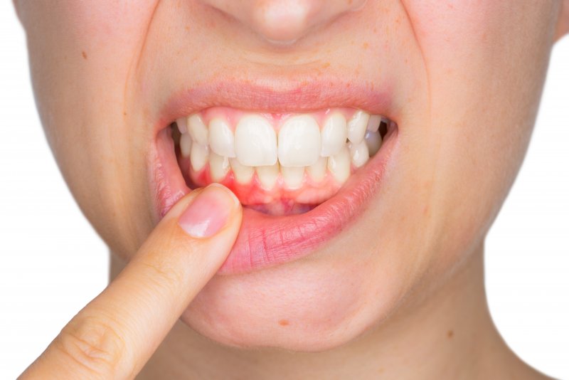 person pointing to red inflamed gums