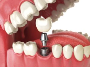 3D illustration of dental implants 