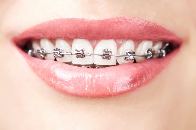 Patient wearing metal braces