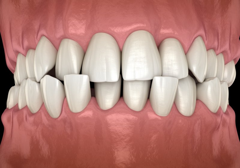 3D illustration of teeth shifting