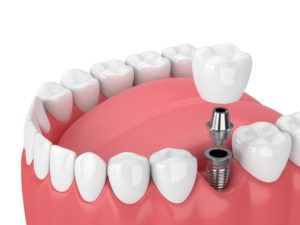 illustration of dental implants