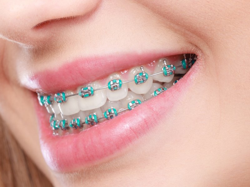 Braces & Swollen Gums Sachse Family Dentistry at Woodbridge