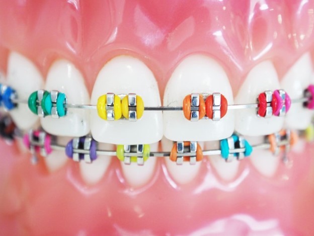 a closeup of colorful braces