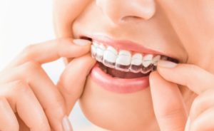 a woman placing Invisalign aligners onto her cavity-free teeth