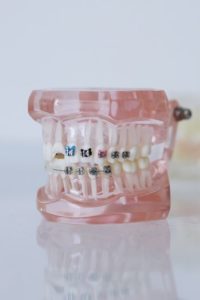 Model of braces on dental mold