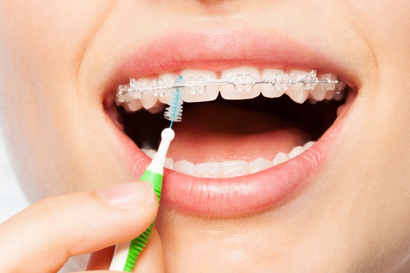 Lower half of person with braces' face showing them using an interdental brush on their braces