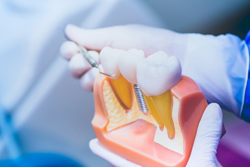 A dentist working with a large dental implant model