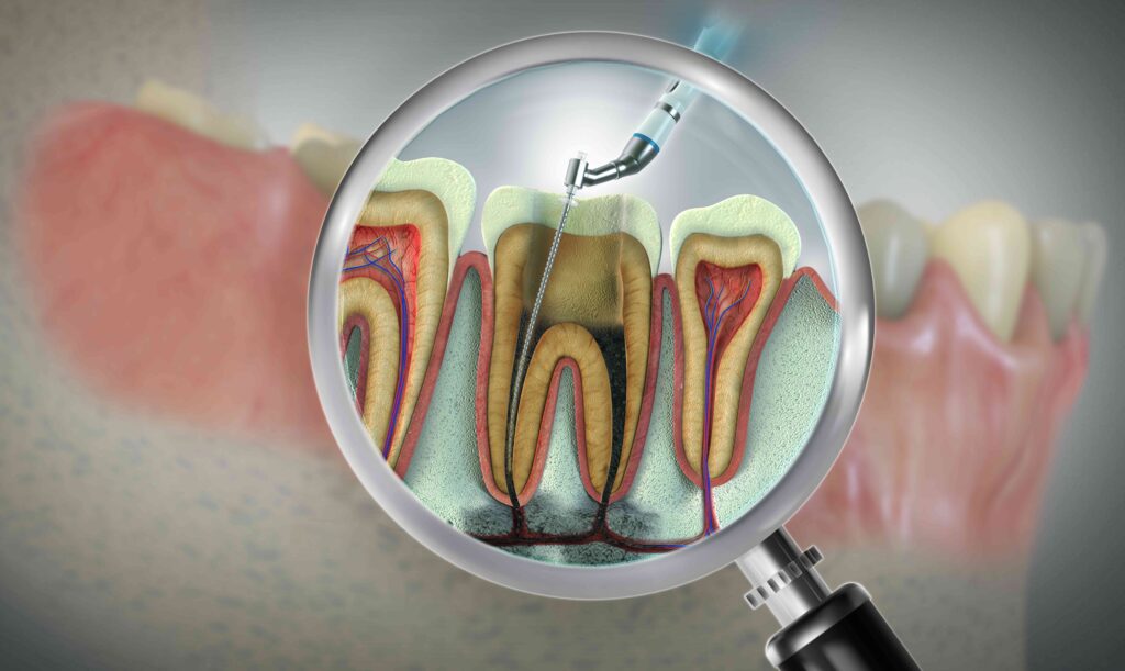 Digital illustration of root canal treatment